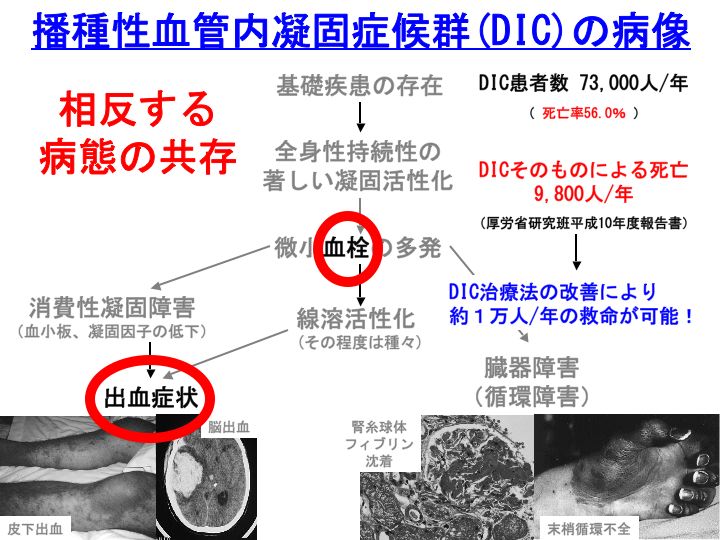 内 血管 播種 症候群 性 凝固