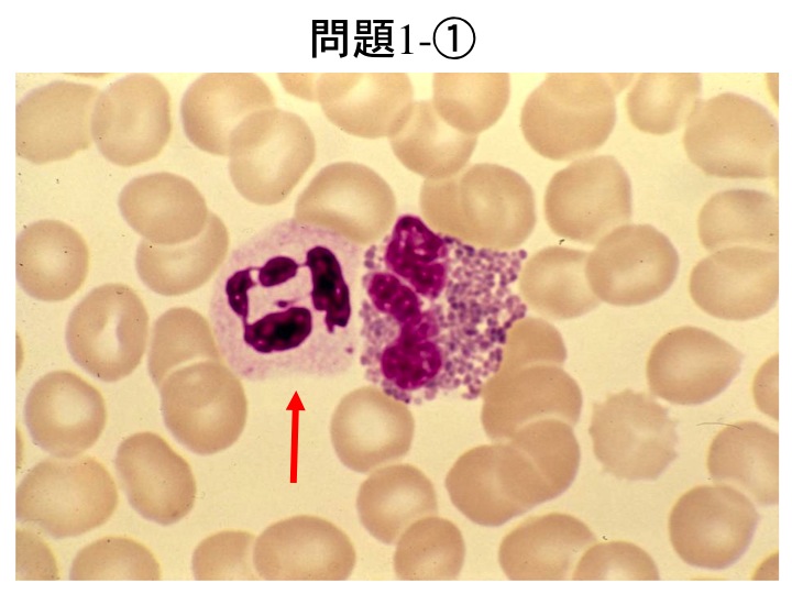 メトトレキサート誘発性汎血球減少症（骨髄 