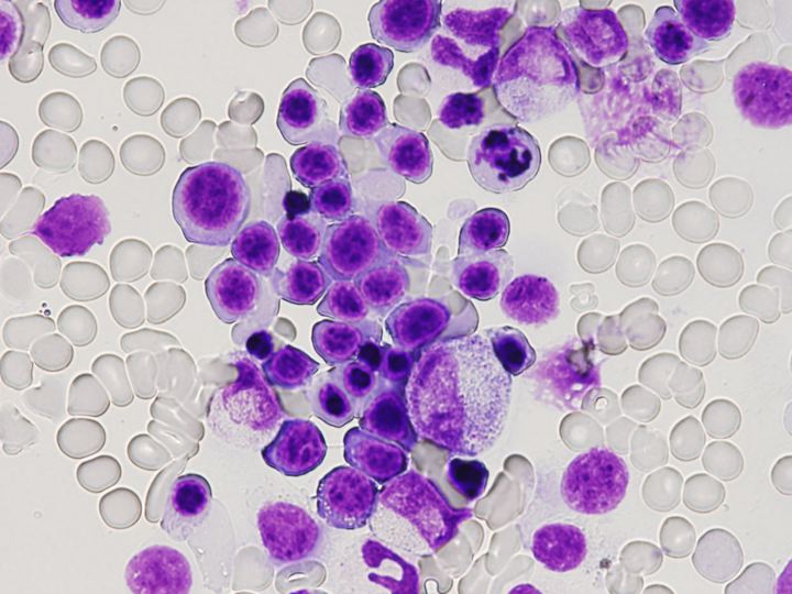 B リンパ腫 性 びまん 大 型 細胞 細胞 再発性の濾胞性リンパ腫とびまん性大細胞B細胞リンパ腫にCMC